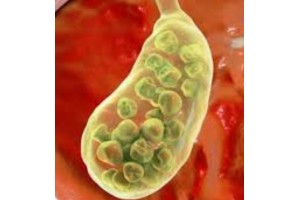 Gallstones, Cholelithiasis