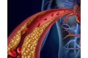 Hypercholesterolemia and Hyperlipidemia