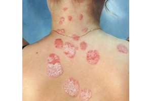 Psoriasis, Eczema