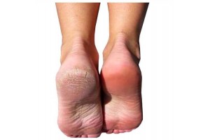 Baby Foot - Foot Peeling for Ideal foot skin