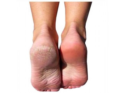 Baby Foot - Foot Peeling for Ideal foot skin